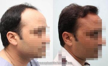 Hair transplantation surgery before and after images