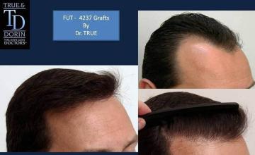 Hair transplantation surgery before and after images