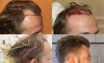 Hair transplantation surgery before and after images