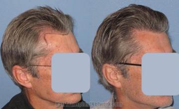 Hair transplantation repair surgery before and after images