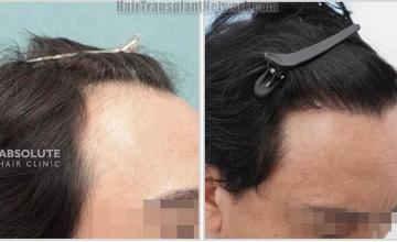 Hair transplantation surgery before and after images