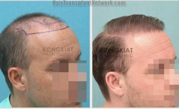 Hair restoration procedure before and after results