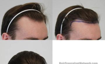 Hair transplantation procedure before and after results