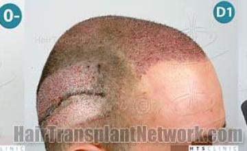 Hair restoration procedure before and after result images