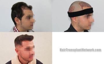 Hair transplantation procedure before and after results