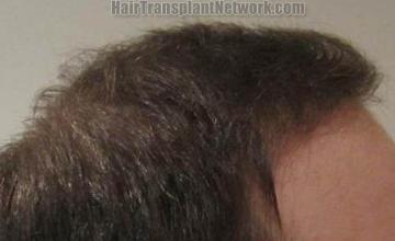 Hair transplantation surgery before and after images