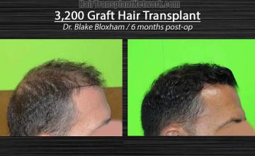 Hair transplant surgery before and after images