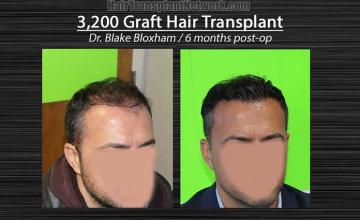 Hair restoration surgery before and after photos