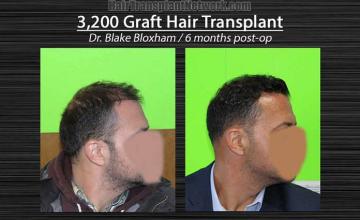 Hair restoration procedure before and after results