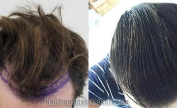 Hair transplantation surgery before and after photos