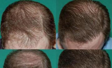 Top views - Before and after two hair restoration sessions