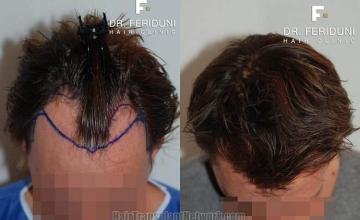 Hair transplantation surgery before and after photos