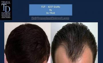 Hair restoration procedure before and after results