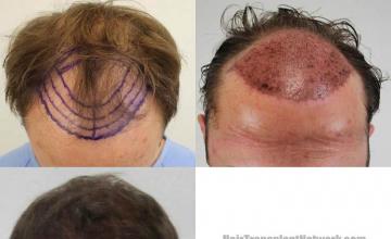 Top view before and after hair restoration results