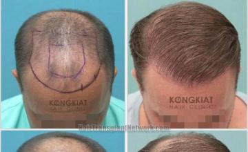 Hair restoration procedure before and after photo results