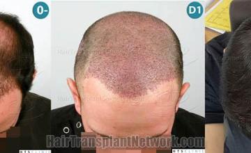 Hair transplantation surgery before and after images