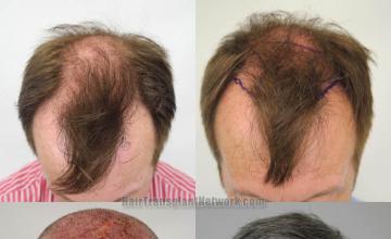 Hair transplantation surgery before and after images