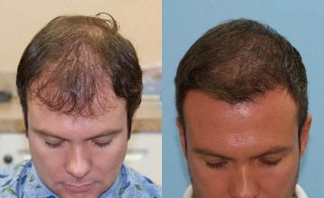 Before and after hair restoration procedure images