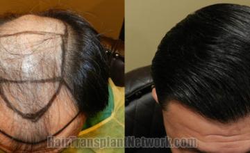 Before and after hair restoration procedure images
