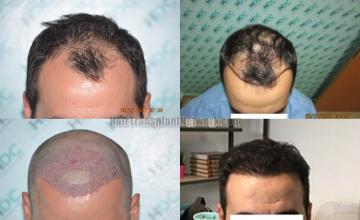 Before and after hair restoration procedure images