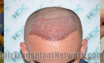 Before and after hair restoration procedure images