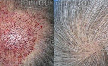 Before and after pictures of  hair transplant to the crown