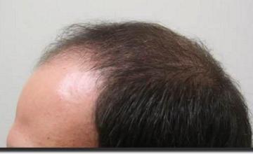 Hair restoration procedure results