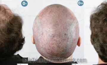 Surgical hair transplantation result photographs
