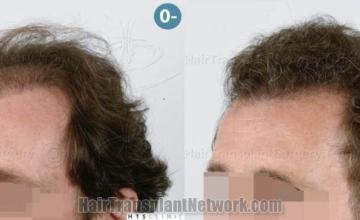 Left view -  before and after photos