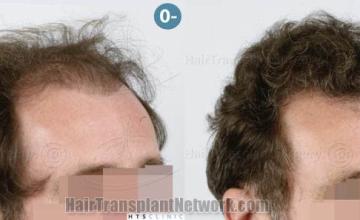  before and after photos