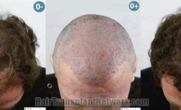 Hair transplantation surgery before and after images