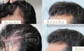 Left view - Before and after hair transplantation photos