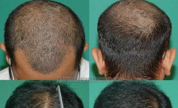 Hair transplantation surgery before and after photos