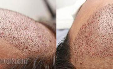 Immediate postoperative images of hair transplant