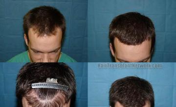 Top view - Before and after hair transplantation images