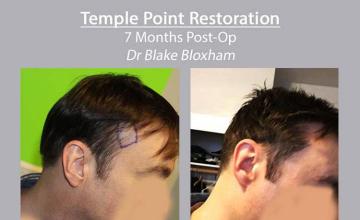 Hair restoration surgery before and after photos