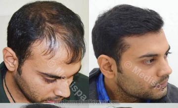 Hair transplantation surgery before and after images