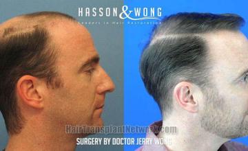 Hair transplantation procedure before and after results