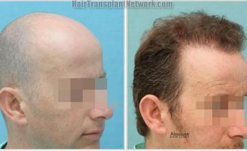 Hair restoration procedure before and after results