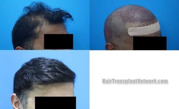  before and after photos