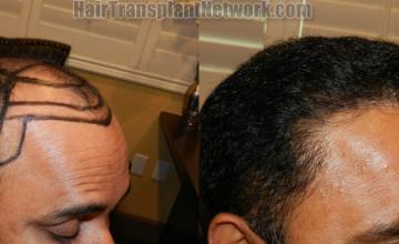 Hair transplantation procedure before and after results