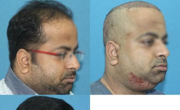 Hair transplantation procedure before and after results