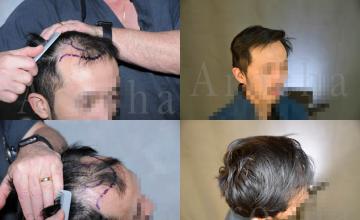 Hair transplantation procedure before and after results