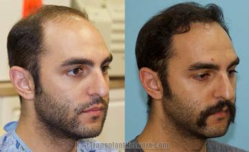  before and after photos