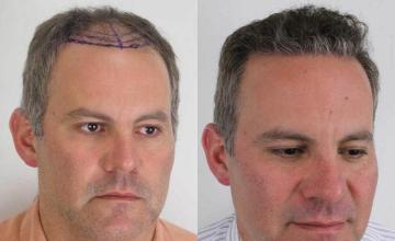 Hair transplantation surgery before and after images