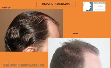 Hair transplantation surgery before and after images