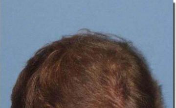 Hair restoration procedure results