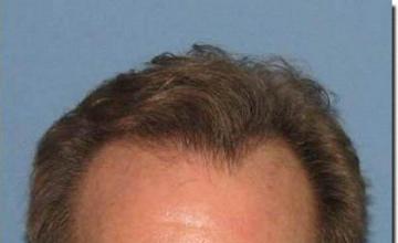 Hair restoration procedure results