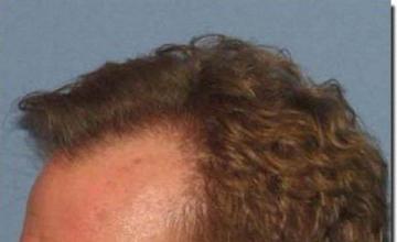 Hair restoration procedure results