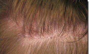 Hair restoration procedure results